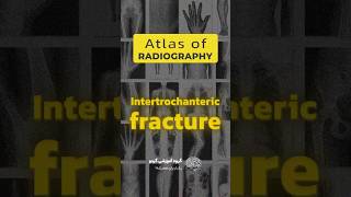 How to treat Intertrochanteric Fracture 🦵🔧 shorts fracture medical [upl. by Kutzer801]