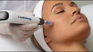 Dermapen Microneedling [upl. by Reine]