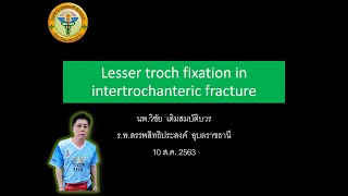 Ep14  Lesser troch fixation in intertrochanteric fracture [upl. by Celestyn263]