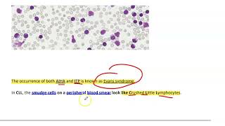 Chronic lymphocytic leukemiaCLL [upl. by Dore786]