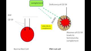 Paroxysmal Nocturnal Hemoglobinuria [upl. by Imac]