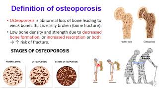 Treatment of osteoporosis [upl. by Lemrac747]