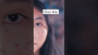 Pimple Solutions amp Clear Skin healthylifestyle pimple skincare [upl. by Oilenroc]