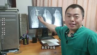 hallux valgus 再说一下痛风和拇外翻的诊断及痛风合并拇外翻是否可以手术？ [upl. by Katey]