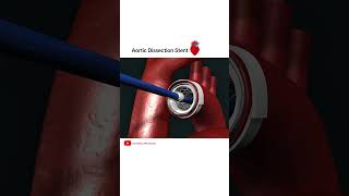 Aortic dissection Stent grafting cardiology shorts [upl. by Notffilc]