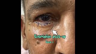 Entropion correction Jones Procedure [upl. by Yanej]