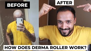 Derma Roller hair regrowth before and after  Does Microneedling actually work in reducing DHT [upl. by Norby6]