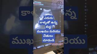 Breech presentation in 9th month drkranthigynecologist తొమ్మిదవ నెల లో ఎదురు కాళ్ళు [upl. by Ennaegroeg]