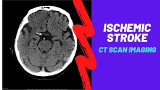 Imaging of Ischemic Stroke For Medical students residents and clinicians [upl. by Ashlee]