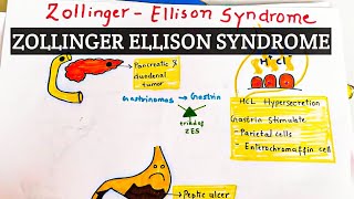 Zollinger Ellison Syndrome  Explained in hindi [upl. by Oisacin328]