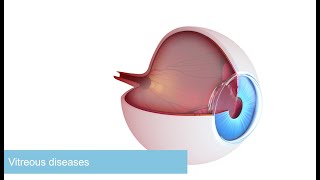 Vitreous body diseases Causes symptoms diagnosis amp treatment Essentials in 3 minutes [upl. by Athena9]