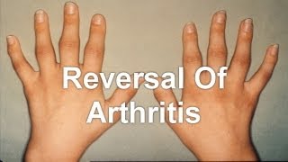 Reversing Arthritis  Reversal Of Arthritis [upl. by Nairam]