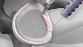 Knotless Shoulder Labral Repair with Arthrex® PushLock® [upl. by Willi]