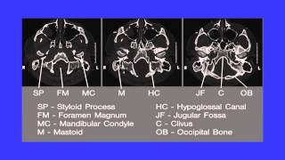 CT MRI TEMPORAL BONE ANATOMY DrAHMED EISAWY [upl. by Grindle]