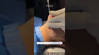 Double Chin Liposuction  Sculpted and Defined Jawline  Dr Kamal [upl. by Volnak]