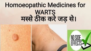 Warts  Warts treatment  मस्से का होम्योपैथिक इलाज [upl. by Anilatac]