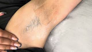 Satisfying underarm waxing results underarmwaxing eyebrows waxing shorts winnipeg viral [upl. by Arym]