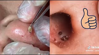 30 Min of the Most Satisfying Pimple Pops amp Cyst Extractions  Ultimate Pimple Popping Compilation [upl. by Anny]