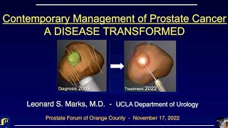 2211 Prof Leonard Marks MD quotContemporary Management of Prostate Cancerquot [upl. by Ruyle]