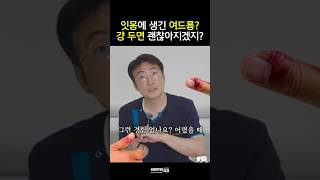 잇몸 고름주머니 그냥 두면 생기는 일 물집 [upl. by Nojid]