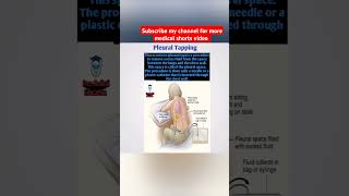 PleuraltapFreeMedicalEducationld3sfviralmedicalviralshortsvideoyoutubeviralshortsnursing [upl. by Emia]