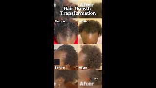 From Hair Loss to Full Edges TheGasheeEffect [upl. by Derian]