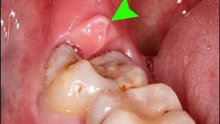 Home management of Painful GumPericoronitis [upl. by Eelloh]