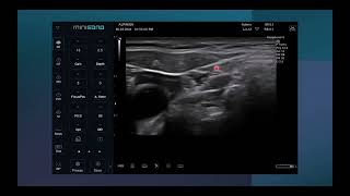 Ultrasound guided IJV central line insertion [upl. by Kushner]