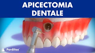 Apicectomia dentale © [upl. by Ardnazxela]