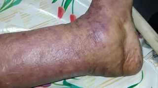 Filariasis  Elephantiasis [upl. by Karlen]