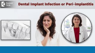 Warning Signs of Infection around Dental Implant  PeriImplantitis DrAditi Garg  Doctors’ Circle [upl. by Nila714]