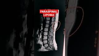 Paraspinal Lipoma mri shorts mriradiographer MRI Dorso Lumbar Spine  T1W Sequence [upl. by Einnil123]