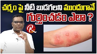 Treatment Of Pemphigus Vulgaris amp Solutions  Dr Anand Kumar Latest Videos RTV Health [upl. by Waterer]