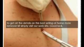 How To Remove A Mole At Home Safely [upl. by Aggri937]