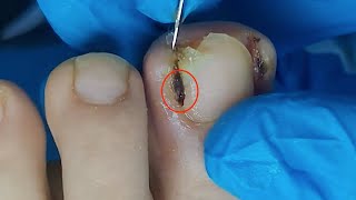 【Daily Pedicure Tutorial】Removing Deeply Embedded Ingrown Toenails on Both Sides of The Big Toe [upl. by Nitsuj355]