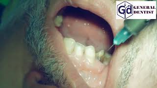 Infiltration anesthesia for treatment 1112 teeth [upl. by Bausch171]