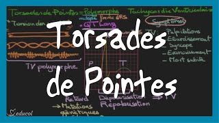 Torsades de pointes ECG symptômes causes et traitement [upl. by Natsrik]