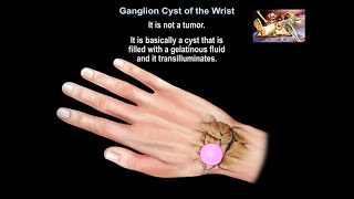 Ganglion Cyst Of The Wrist  Everything You Need To Know  Dr Nabil Ebraheim [upl. by Wilmar]