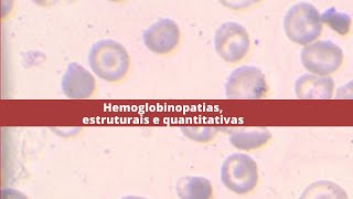 Hemoglobinopatias estruturais e quantitativas [upl. by Vandyke]