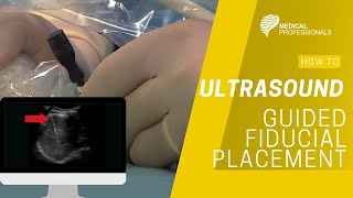 Ultrasound Guided Fiducial Placement for Stereotactic Radiotherapy [upl. by Atirac]