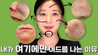 다 이유가 있다 부위별 여드름 없애는 방법🆘 [upl. by Nataniel]