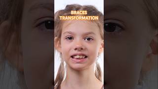 Braces transformation braces orthodontist bracelet dentist dent [upl. by Landa429]