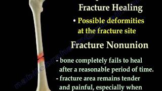 Fracture Healing Part 1  Everything You Need To Know  Dr Nabil Ebraheim [upl. by Yul]