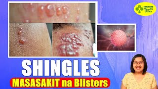 MASAKIT na Blisters Dulot ng SHINGLES  Varicella Zoster Virus  Tagalog Health Tips  Nurse Dianne [upl. by Yllim]