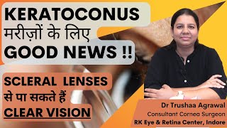 Scleral Contact Lenses  How to insert and remove  Now get clear vision in Keratoconus [upl. by Bowman]