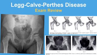 LeggCalvePerthes Disease Coxa Plana Exam Review  Rachel Goldstein MD [upl. by Wei]