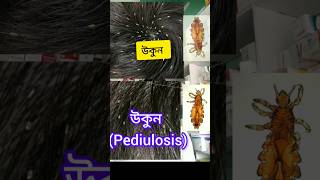 Pediulosis উকুন [upl. by Anelhtac925]