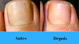 Como eliminar Micose das Unhas [upl. by Adaran686]