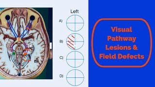 Visual pathway lesions and field defects [upl. by Leahcin136]