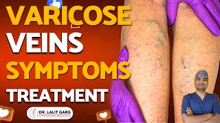 Varicose Veins Symptoms Causes Diagnosis Prevention and Treatment By Dr Lalit Garg [upl. by Etnad522]